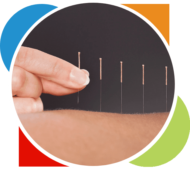A person is holding onto acupuncture needles