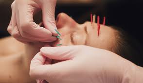 Close-up of acupuncture needles being inserted into a person's face.