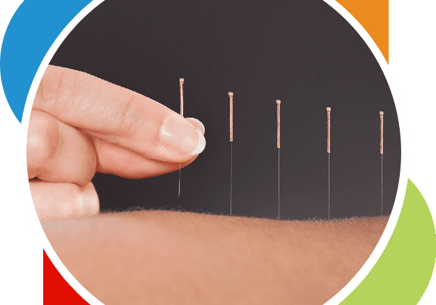 A person is holding onto acupuncture needles